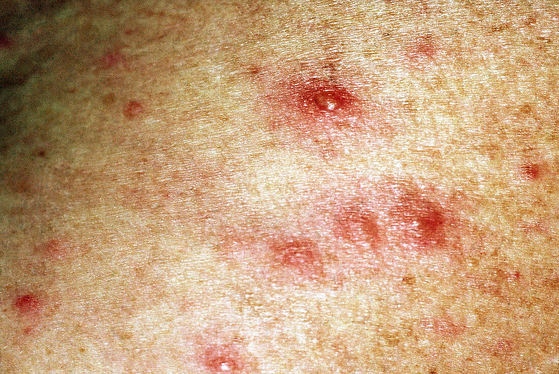 Disseminated Herpes Zoster