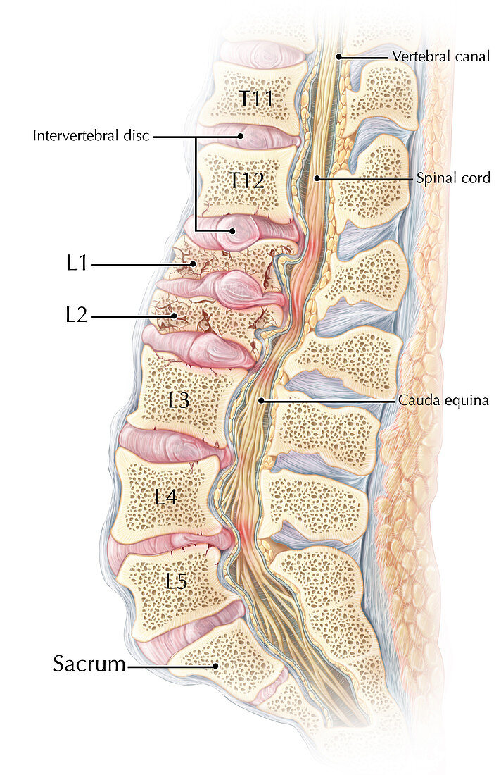 Lumbar Compression Fracture
