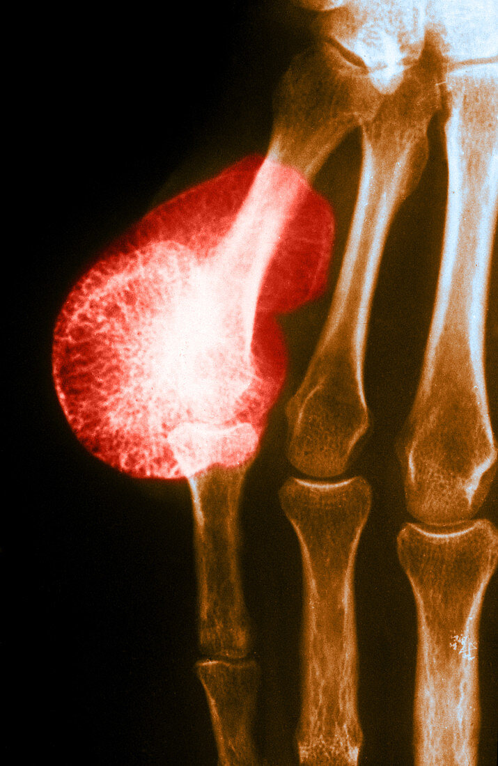 Osteoma on Finger,X-ray