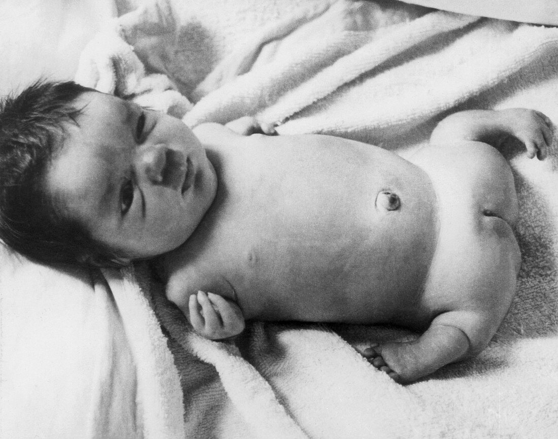 Thalidomide Baby