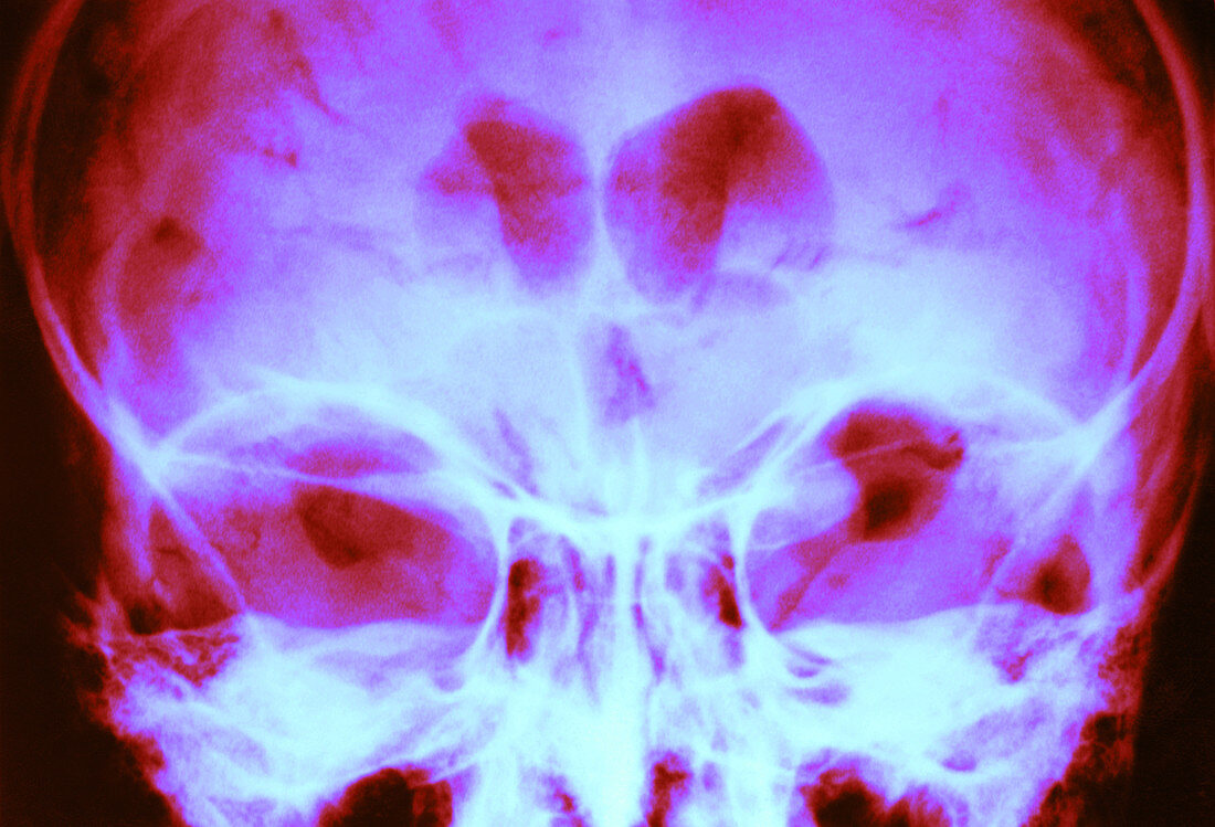 Normal encephalogram