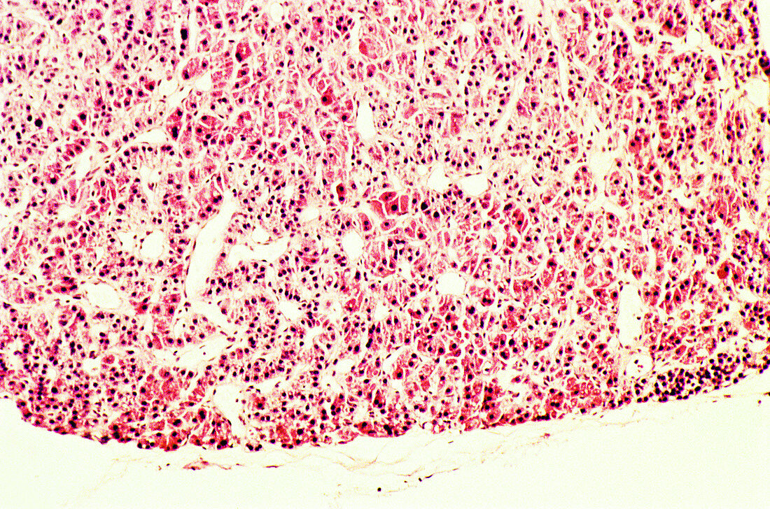Benign Adenoma in Parathyroid Gland,LM