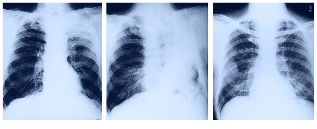 Lung Cancer,Pre- and Post-Op