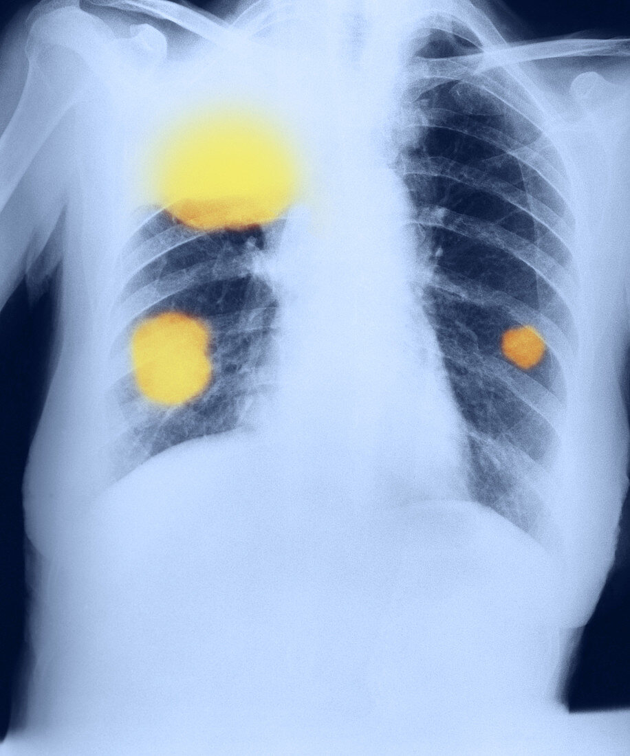 Cancerous Lung Tumours