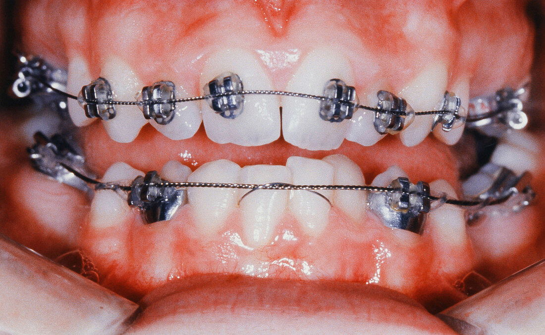 Braces Bonded to Teeth