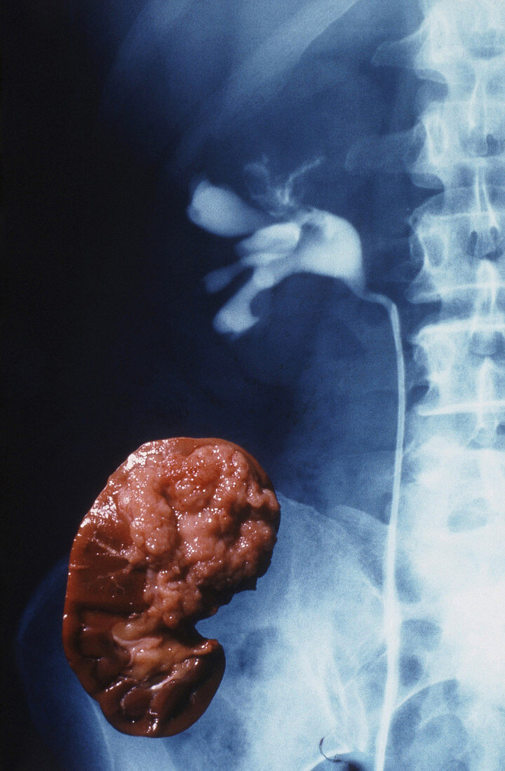 Kidney Papilloma