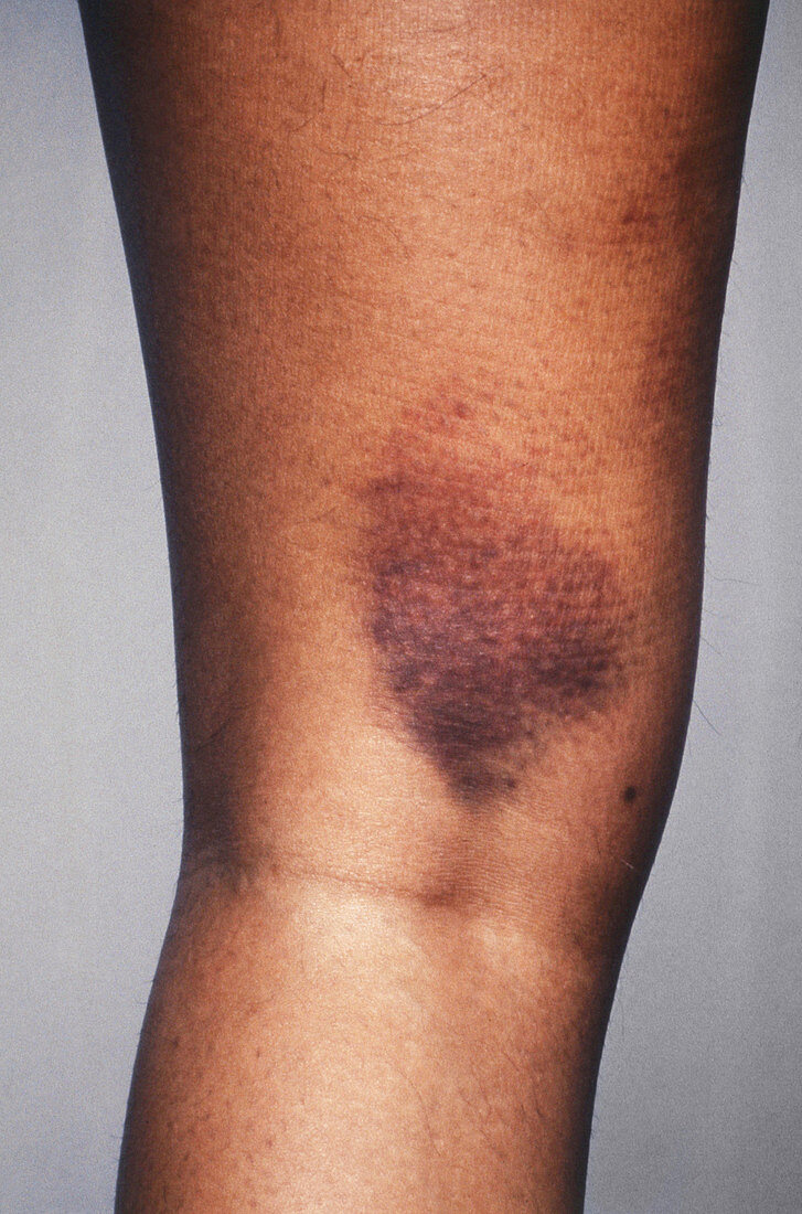 Bruise on Leg