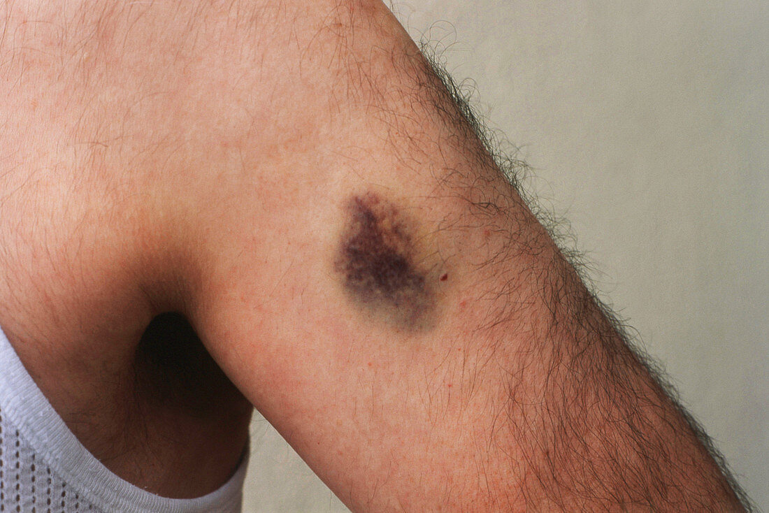 Bruise on Arm