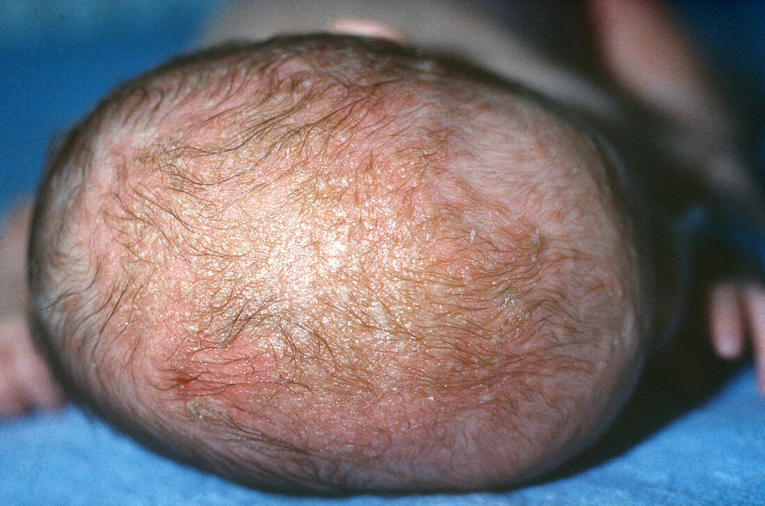 Seborrheic Dermatitis Acheter Une Photo 12035372 Science Photo Library