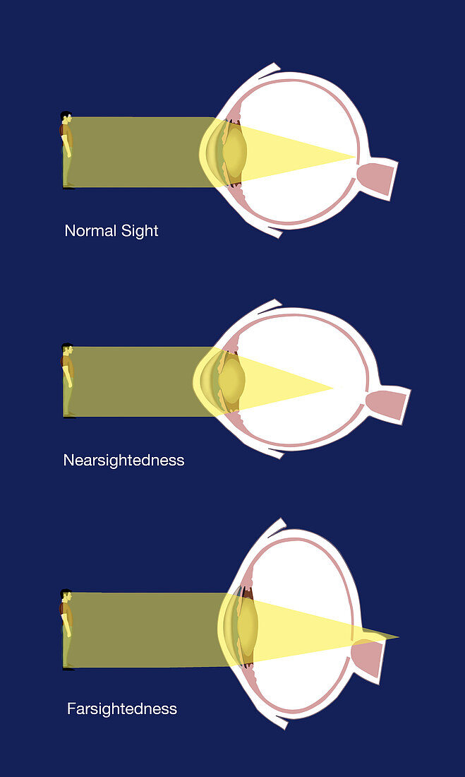 Normal,Nearsighted and Farsighted Vision