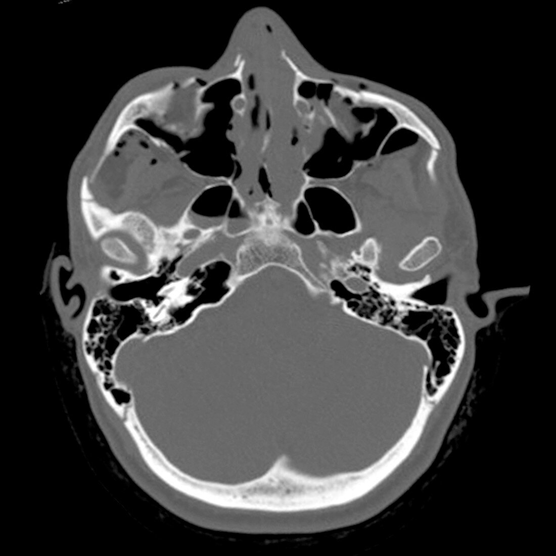 Severe Facial Fractures (CT Scan)