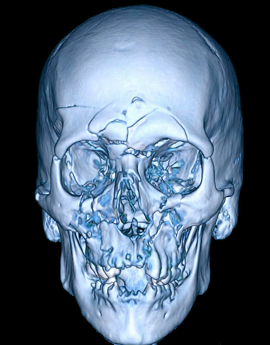 Enhanced 3D CT of Severe Facial Fractures