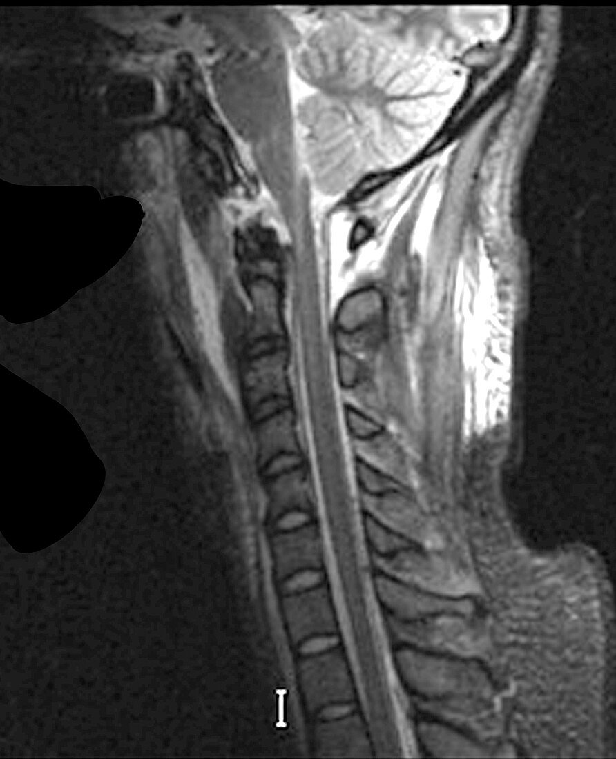 Cranio-Cervical Dissociation (MRI)