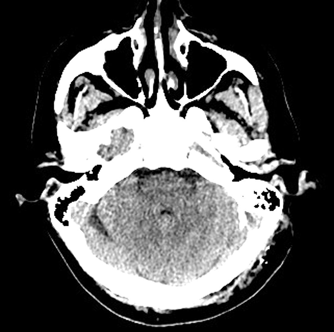 Arnold-Chiari Malformation (CT Scan)