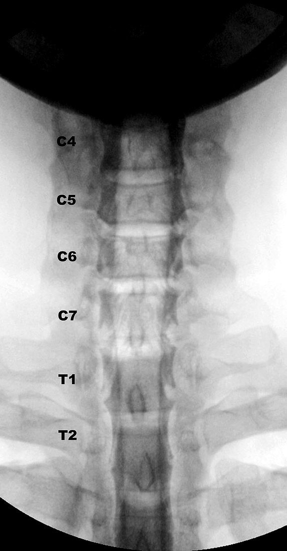 Cervical Myelogram (X-ray)