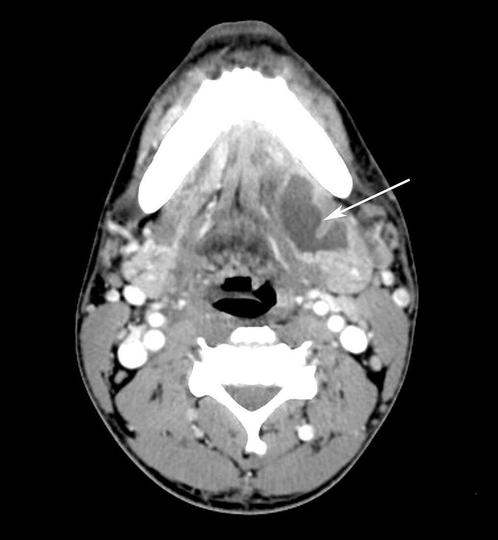 Submandibular Gland Abscess (CT Scan)