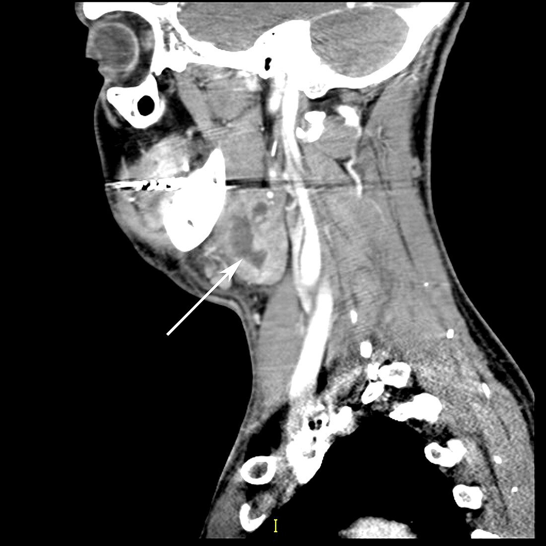 Submandibular Gland Abscess (CT Scan)