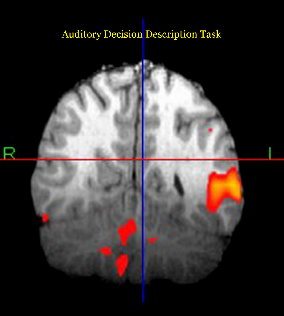 Brain Activity during Language Task