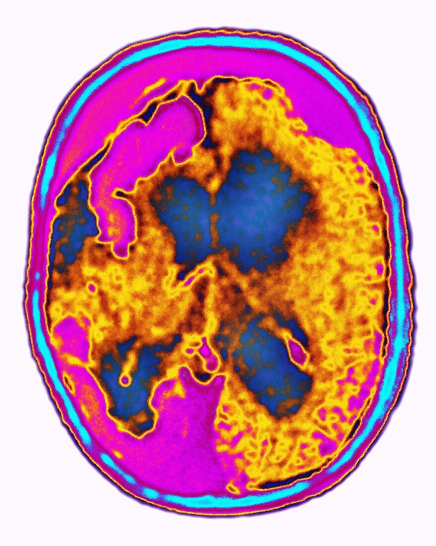 Brain Angioma,MRI