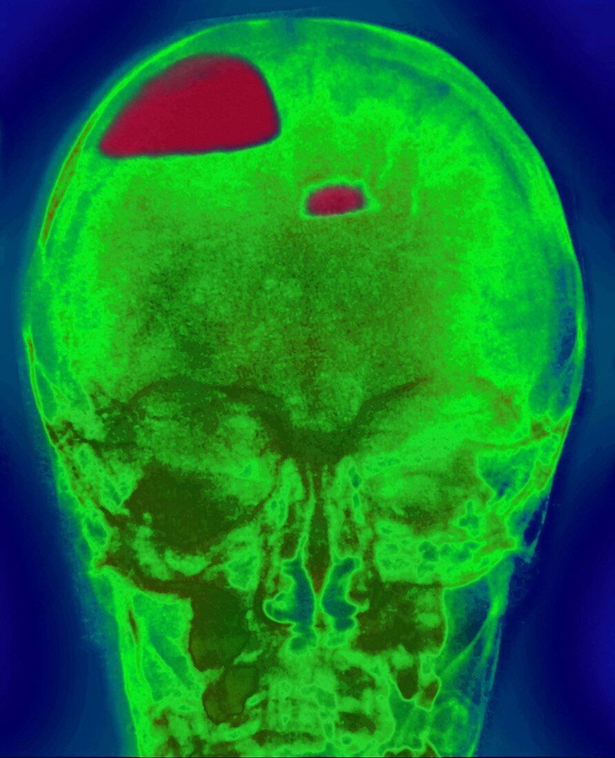 Cerebral Hemorrhage in Infant,X-ray