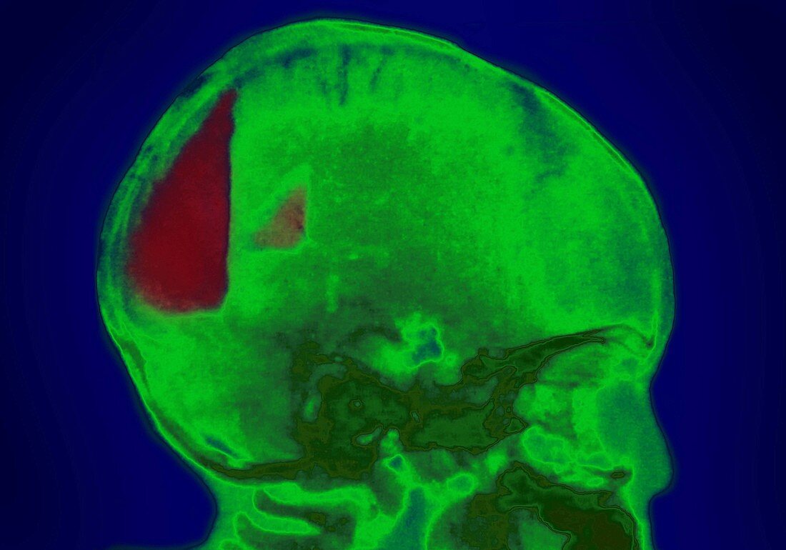Cerebral Hemorrhage in Infant,X-ray
