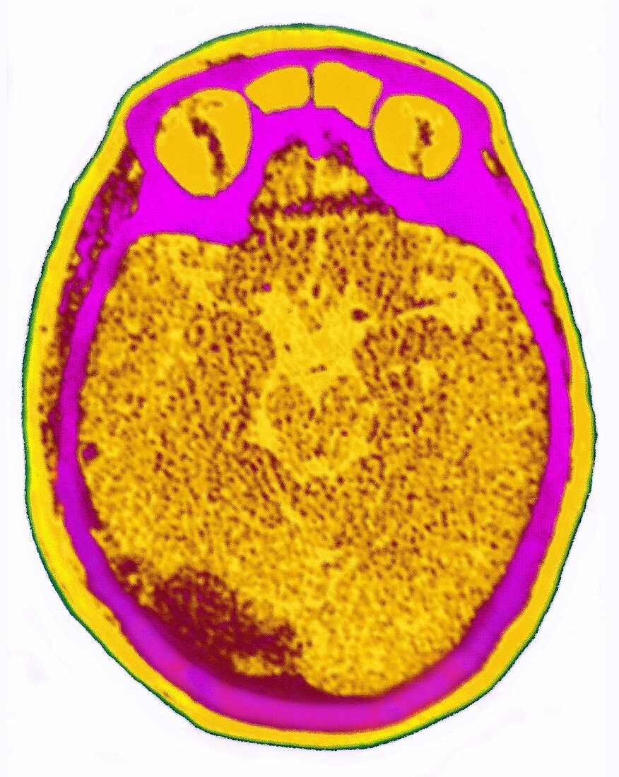 Brain Stroke,MRI