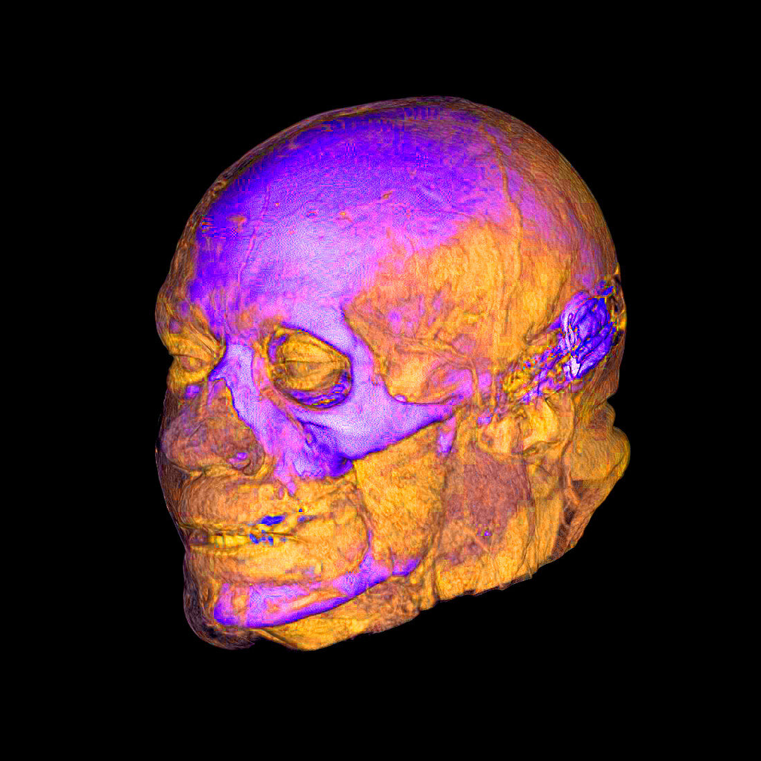 Enhanced 3D CT of Face and Skull