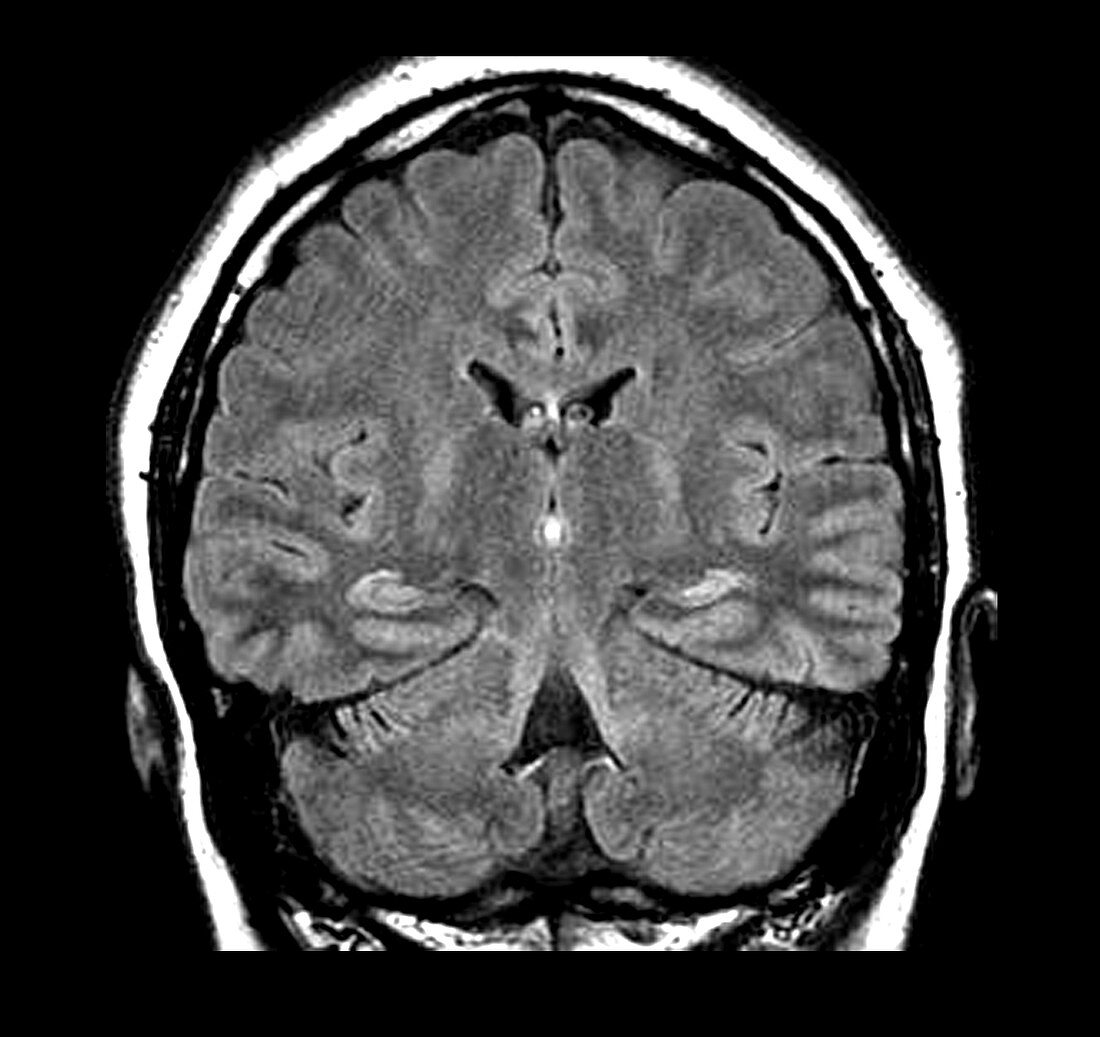 MRI of Mesial Temporal Sclerosis