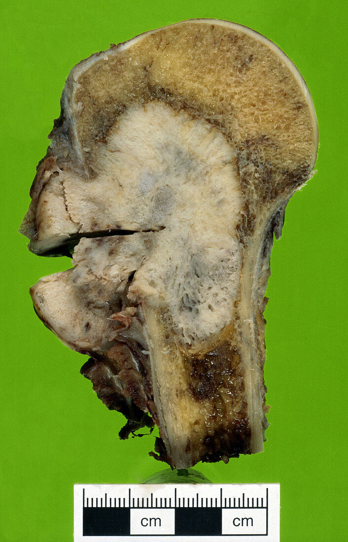 Femur with Metastatic Adenocarcinoma