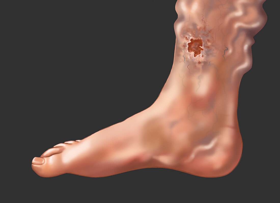 Skin Ulcer from a Varicose Vein