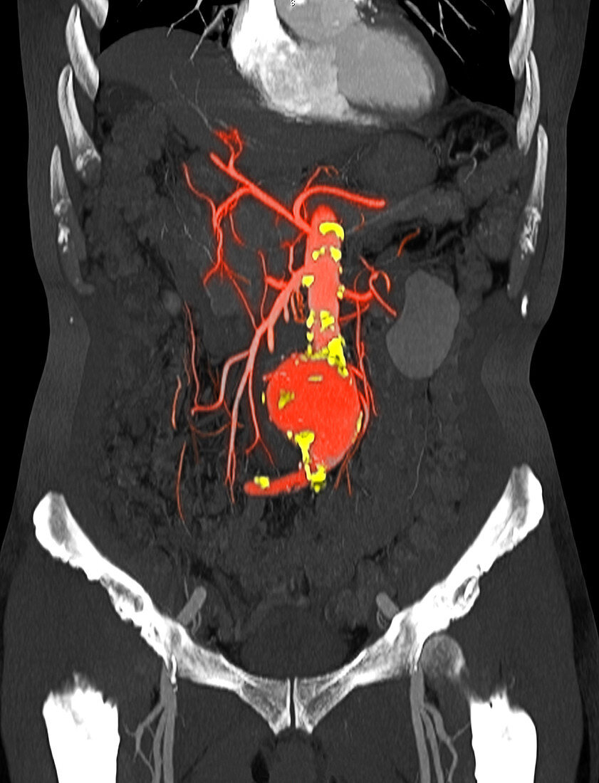 CT Scan of Abdominal Aortic Aneurysm