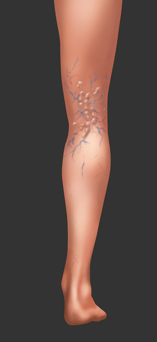 Varicose Veins