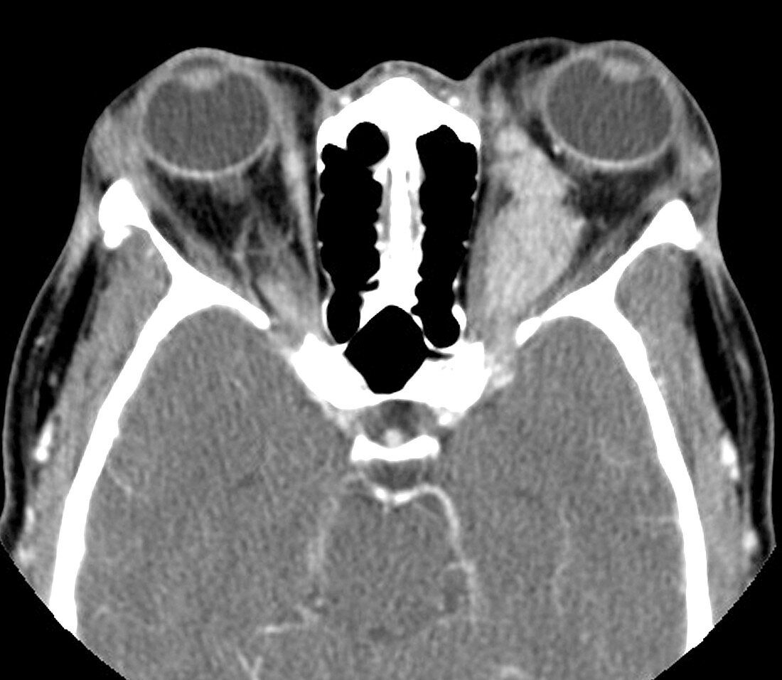 Orbital and Deep Facial Lymphoma