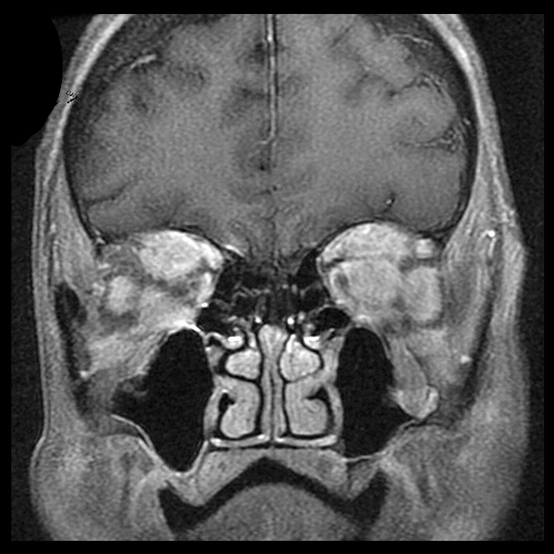 Orbital and Deep Facial Lymphoma (MRI)