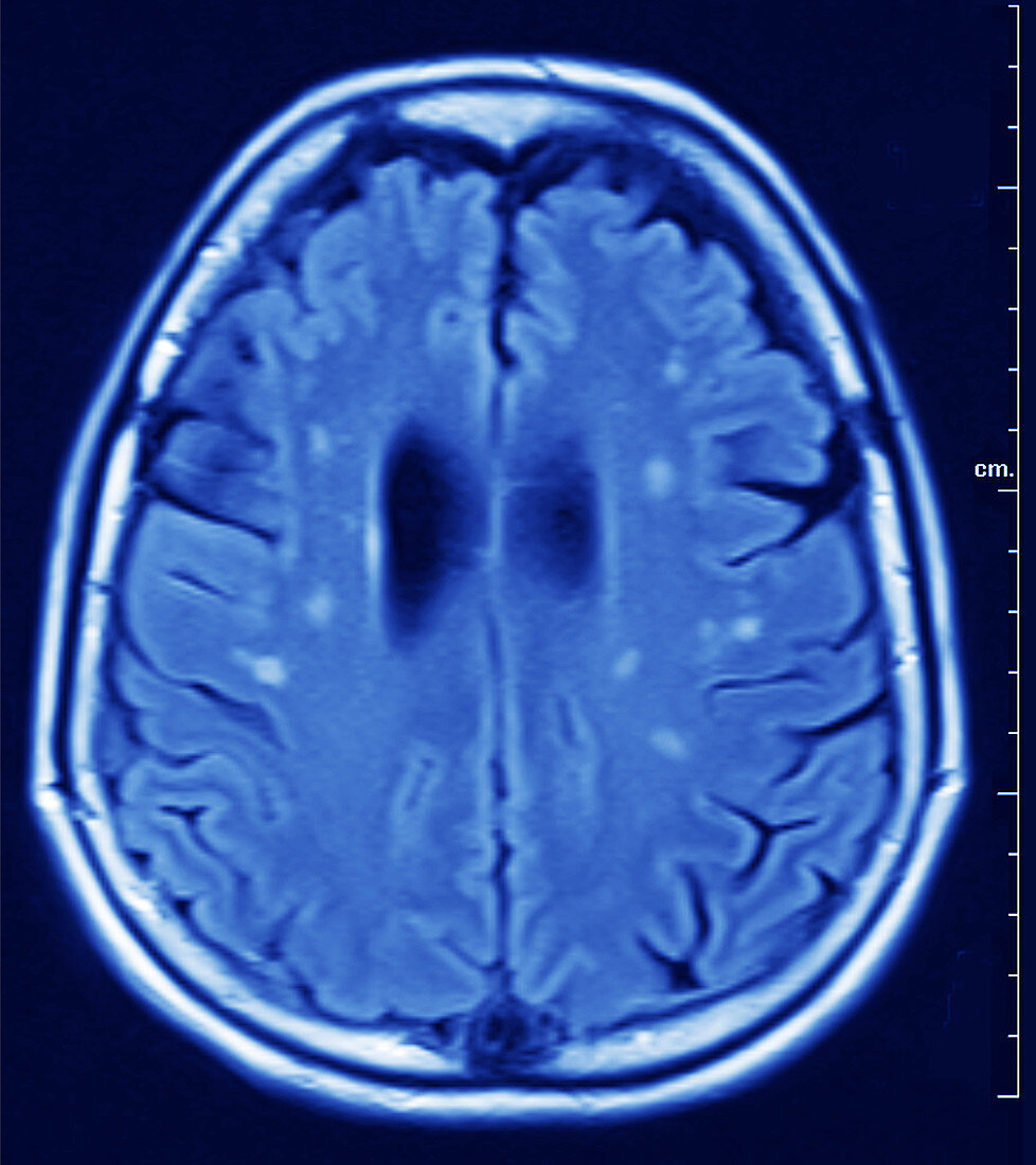 Brain MRI,White Matter Hyperintensities