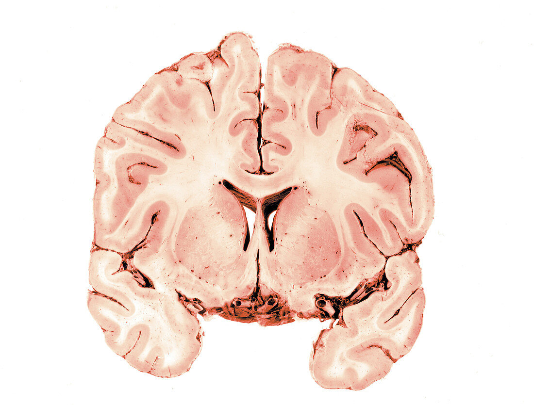 Coronal Section of Brain