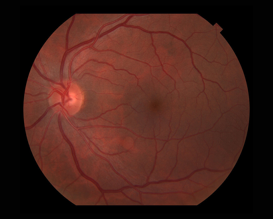 Retinal Cyst