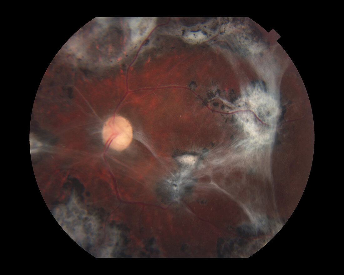 Proliferative Diabetic Retinopathy