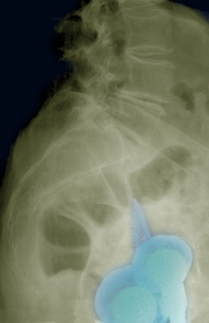 Double Hip Replacement,X-ray