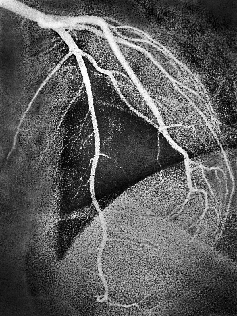 Left Coronary Artery