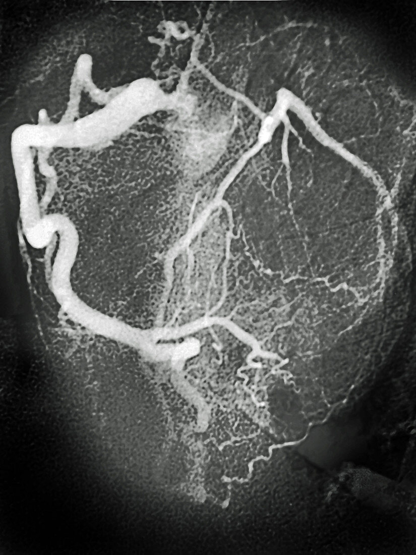 Coronary Artery