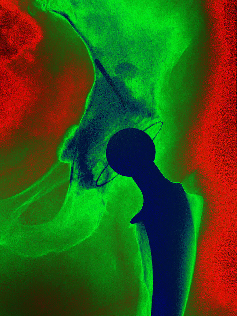 Hip Replacement,X-ray