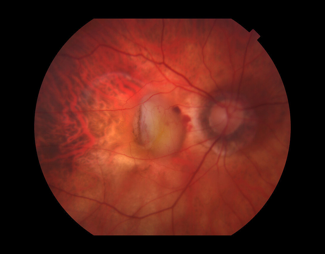 Wet Age-Related Macular Degeneration