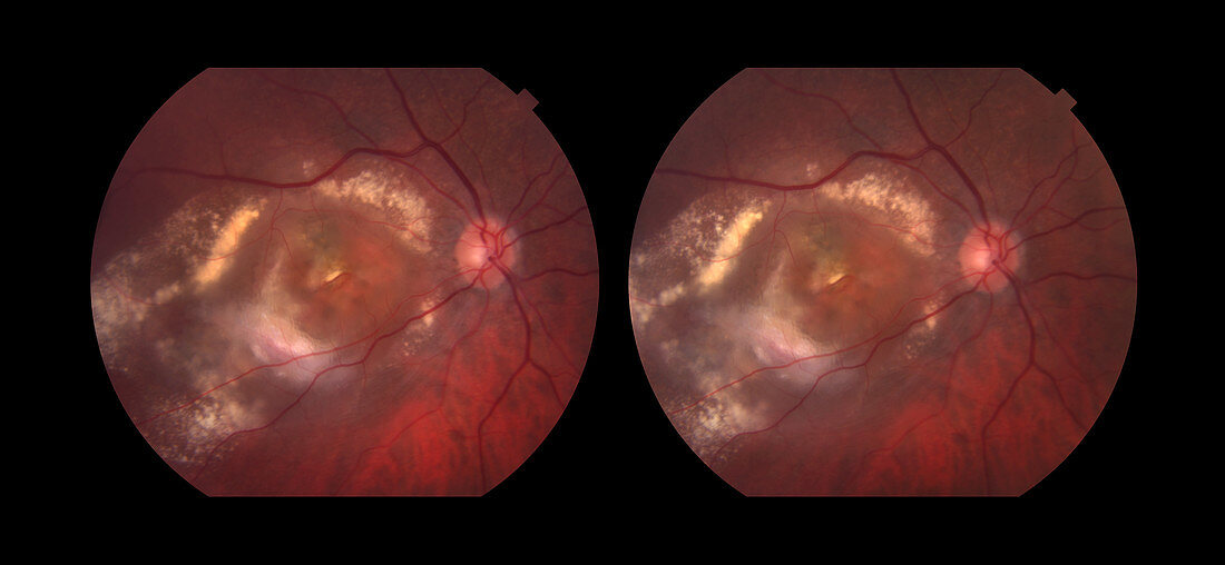 Wet Age-Related Macular Degeneration