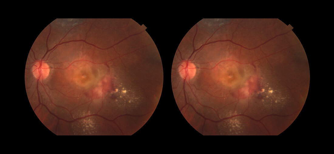 Wet Age-Related Macular Degeneration