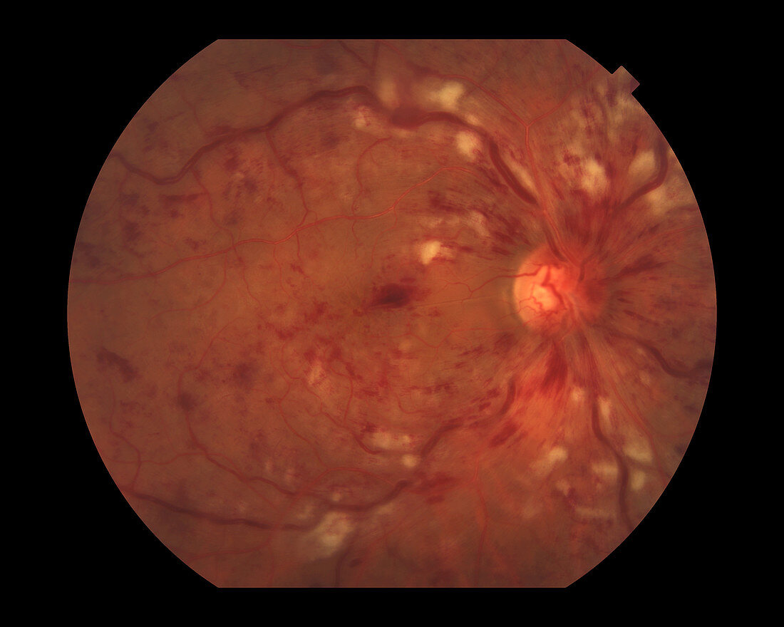 Central Retinal Vein Occlusion