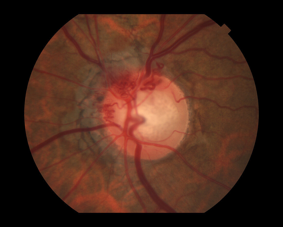 Collateral Vessels in Glaucoma Patient