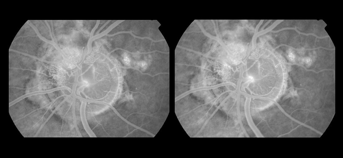 Collateral Vessels in Glaucoma Patient