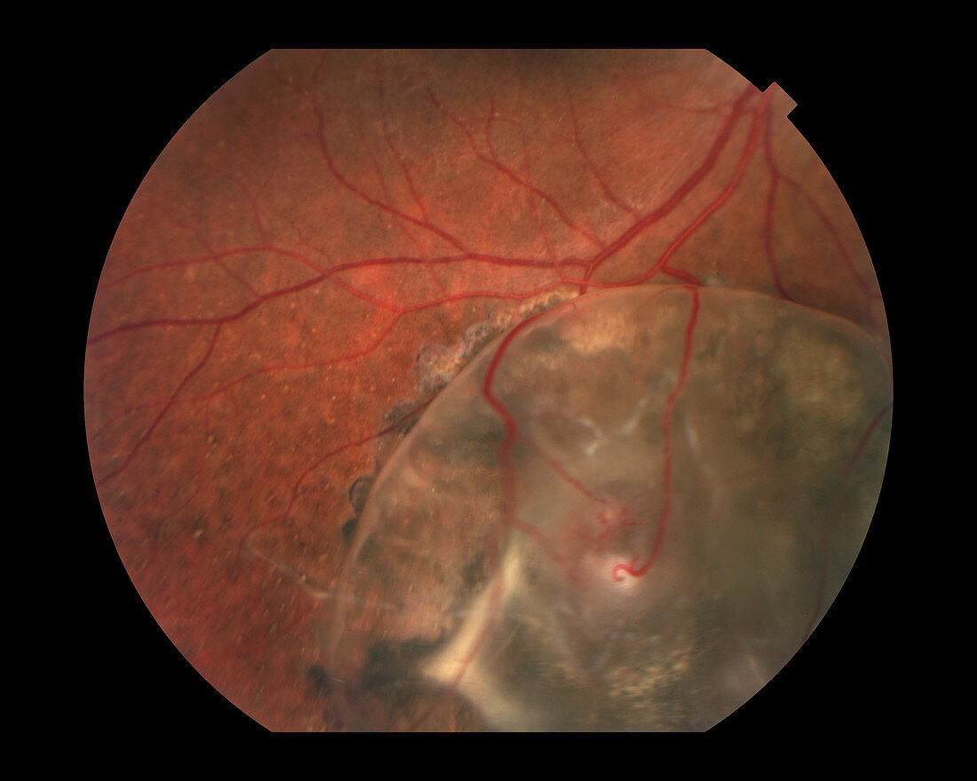 Uveal Effusion Syndrome