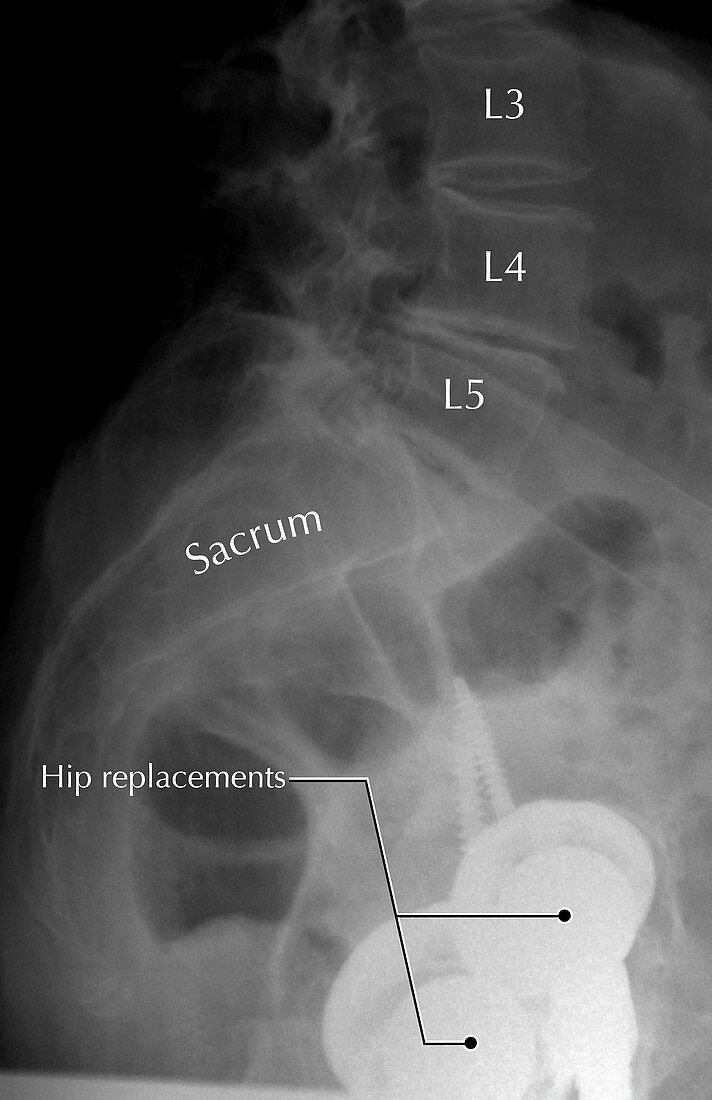 Double Hip Replacement,X-ray